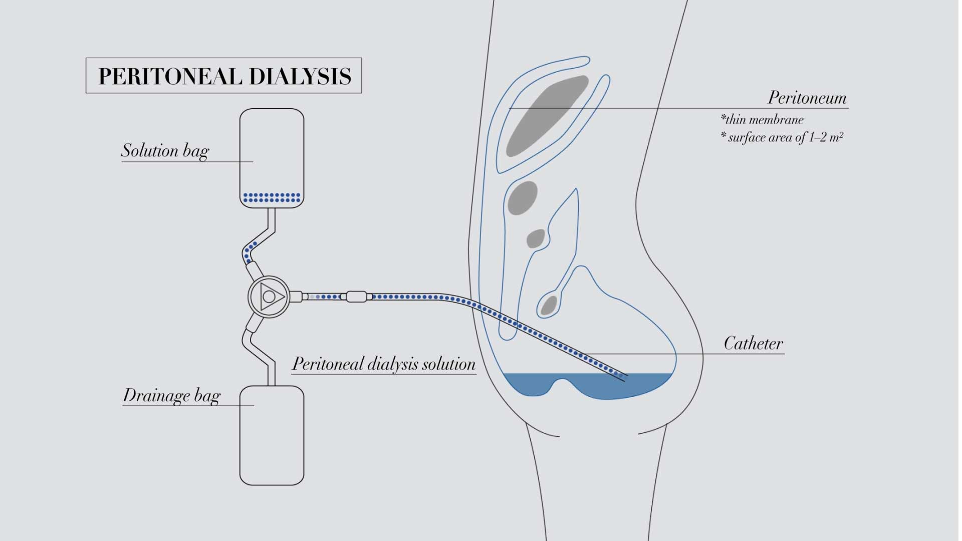 Перитонеальный диализ что это. Перитонеальный диализ схема. Перитонеальный гемодиализ. Перитонеальный диализ фото. Перитонеальный катетер.